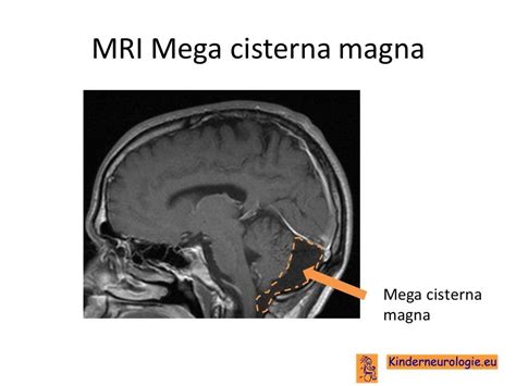 mega cisterna magna dangerous